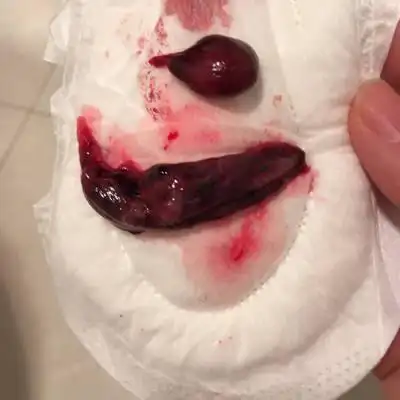 先兆流产,腹痛一天流出来的东西,其中有孕囊吗