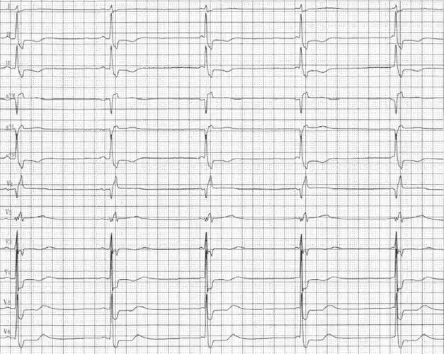 交界性心搏心律心电图