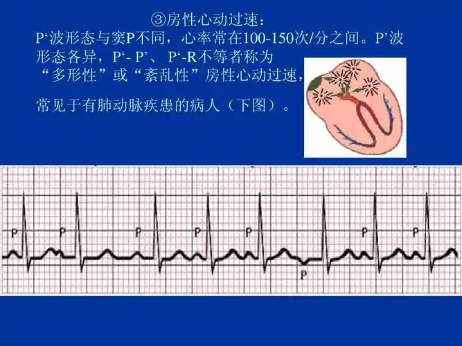 2011新版临床心电图教程(协和医院内科)ppt