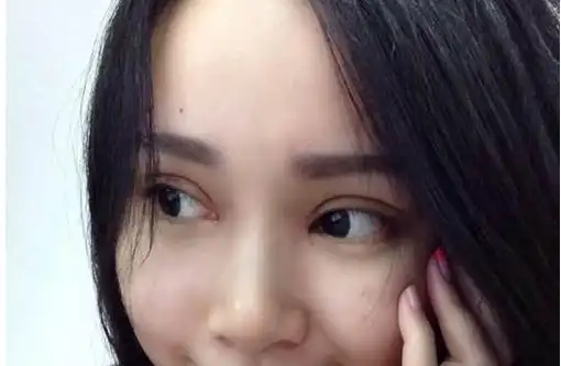 全切双眼皮 去皮去脂 开眼角一个月了