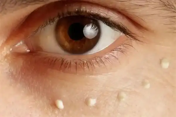 脂肪粒一般长在哪里