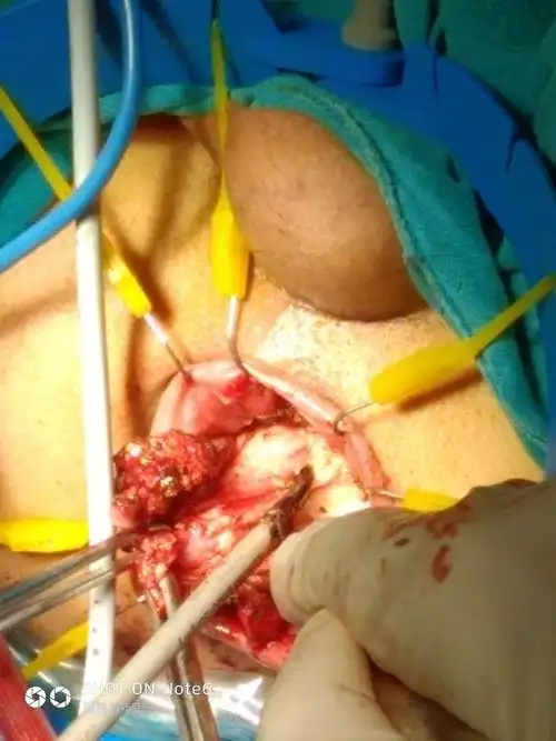 直肠脱垂粘膜加直肠息肉经肛门切除术