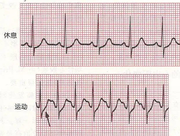 临床实用心电图入门 第十三讲 st段改变与心肌缺血