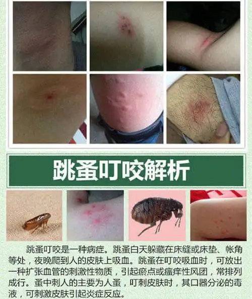 驱i蚊膏被毒虫红蚂蚁咬伤螨虫跳蚤蚊虫叮咬止痒皮肤瘙痒过敏消包紫草