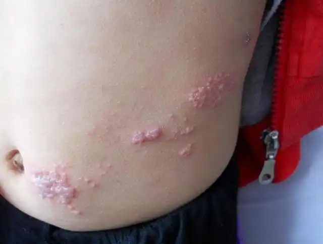 看起来就像蛇缠在腰间一样,因此,蛇缠腰其实就是带状疱疹