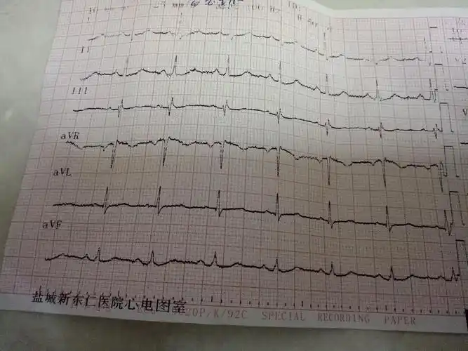 女52岁体检发现心肌供血不足附心电图如何调理