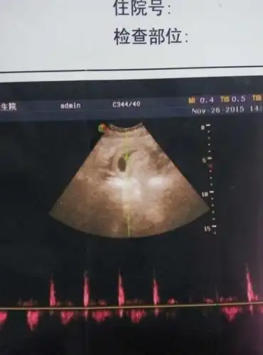 在线的宝妈帮忙看看50天的孕囊4.2/2.