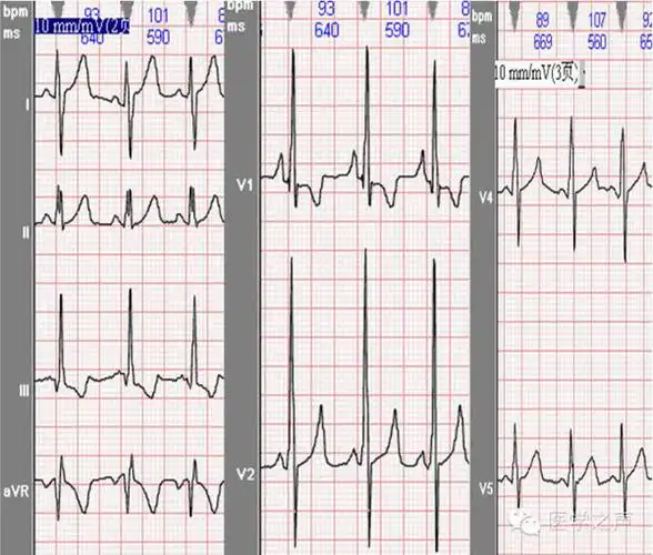 心电图课堂|第5期:右室肥大与双侧心室肥厚