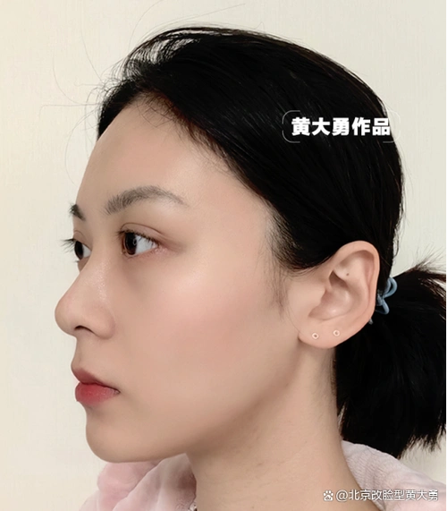 24岁小姐姐下颌角术后4个月 方圆脸秒变瓜子脸