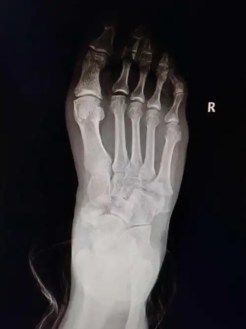 一例足舟骨第五跖骨基底粉碎性骨折的治疗