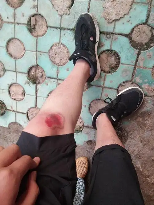 半个月前摔一跤膝盖破了挺大块皮今天纱布能拆一半了拆完这样子会留疤