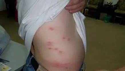 蜱虫咬人后的伤口图真实案例被蜱虫叮咬差点丢失性命