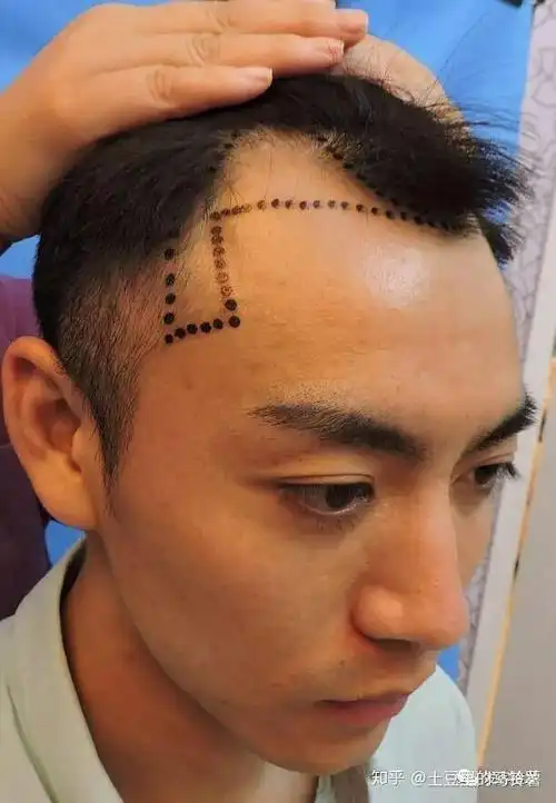 植发三年后的我,效果怎么样?