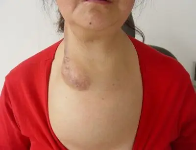 时间: 2011-04-06 来源: 天津市肿瘤医院