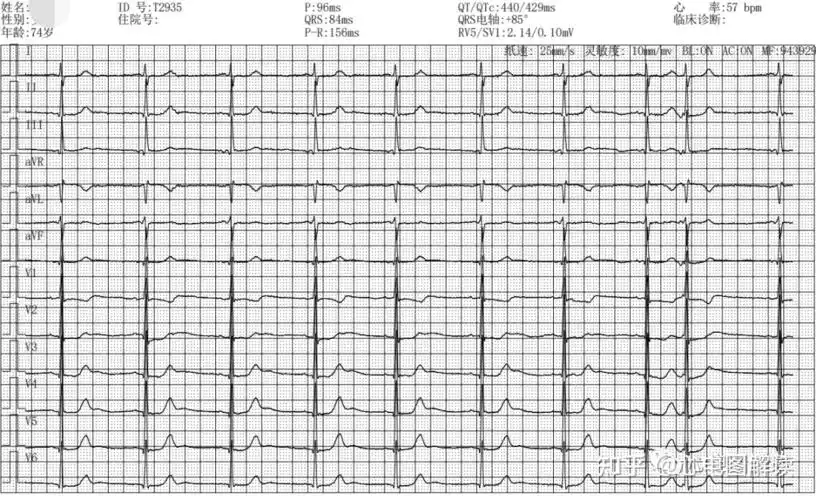 1图14 人赞同了该文章欢迎大家走进心电图的世界心电图解读