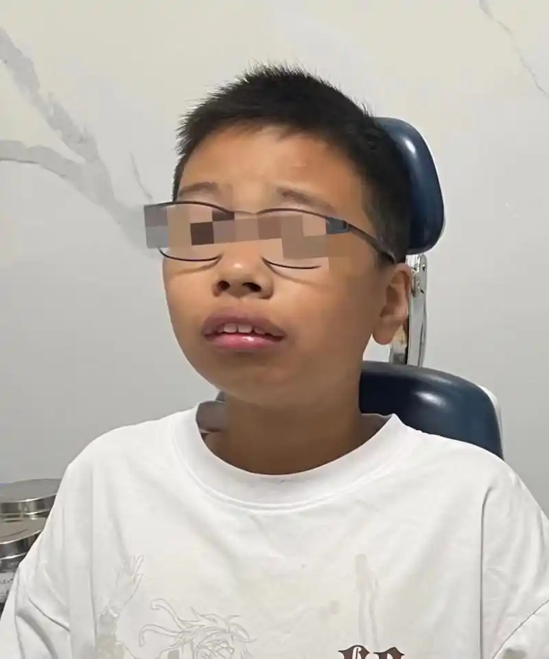 爸妈很后悔-12岁儿子腺样体面容92 【暑期学生就诊高峰期】 今天