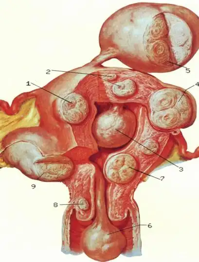 figo子宫肌瘤分型示意图