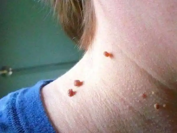 肉粒疣的图片(脖子上长的小肉粒是什么) - 赤虎壹号