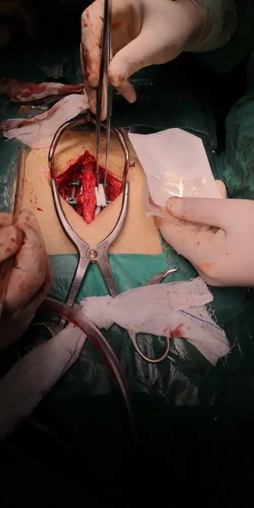 骨折复位,椎板开窗减压,骨水泥钉棒系统内固定术