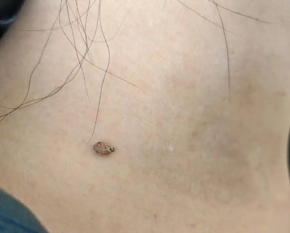 周前来看脖子上的寻常疣,今天给我私信说已经脱落了,问我是否继续用药