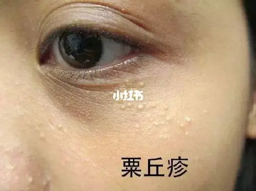 在美容界通常会把"粟丘疹,汗管瘤"俗称脂肪粒,大多数是指粟丘疹.