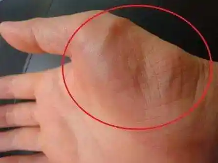 "鼠标手"长期不治,可能导致手部肌肉萎缩