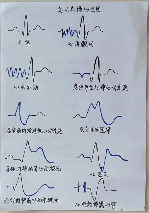 医生教你简单快速看心电图,建议收藏!