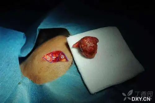 【讨论】面部较大表皮囊肿切除 [病例帖]