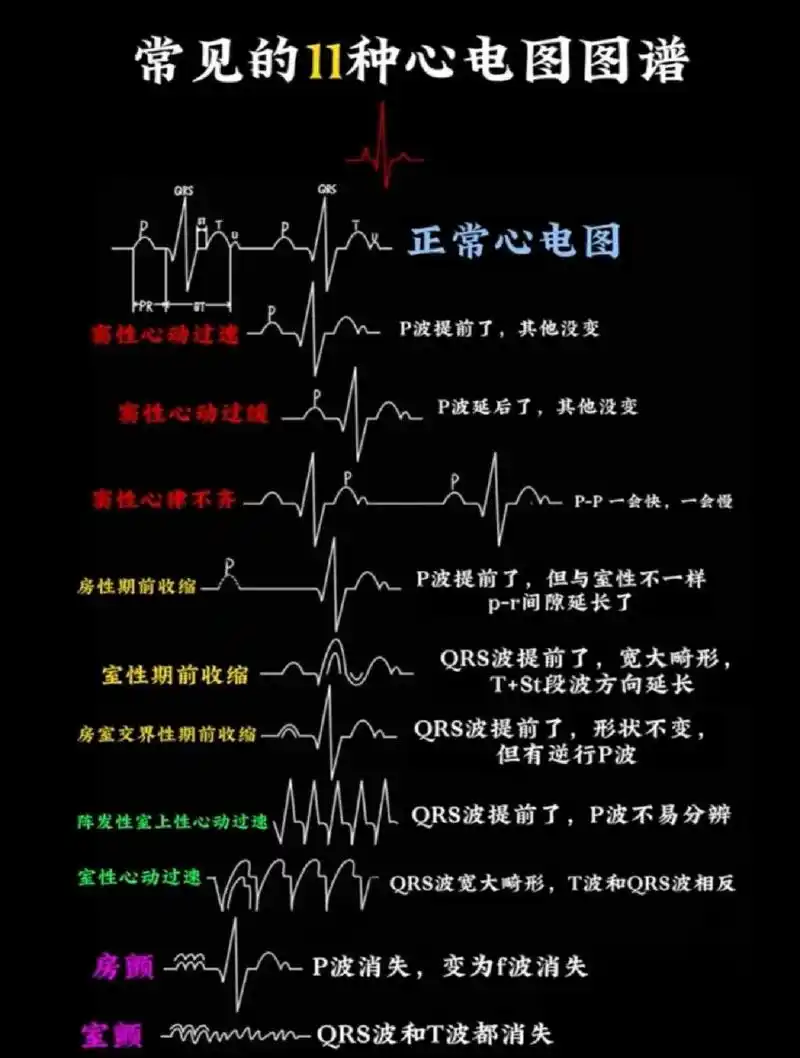 常见的11种心电图 小主们点赞收藏