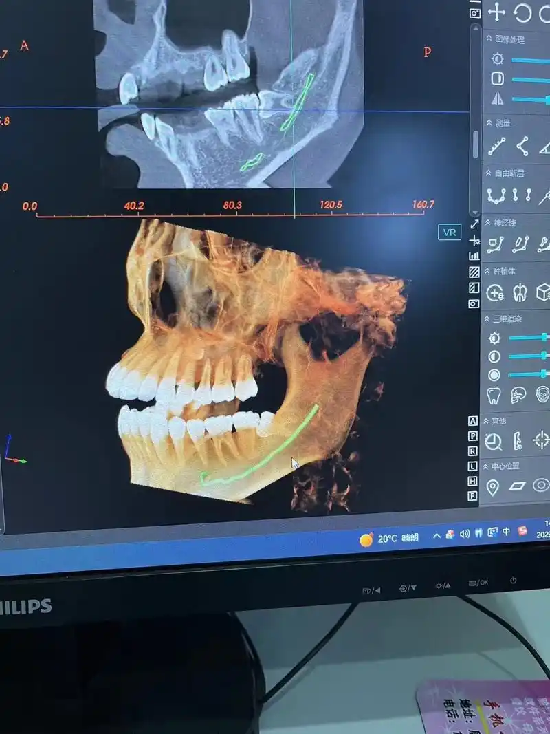 19医师节.#医者仁心 #拔智齿 #口腔ct图片 #牙医 - 抖音