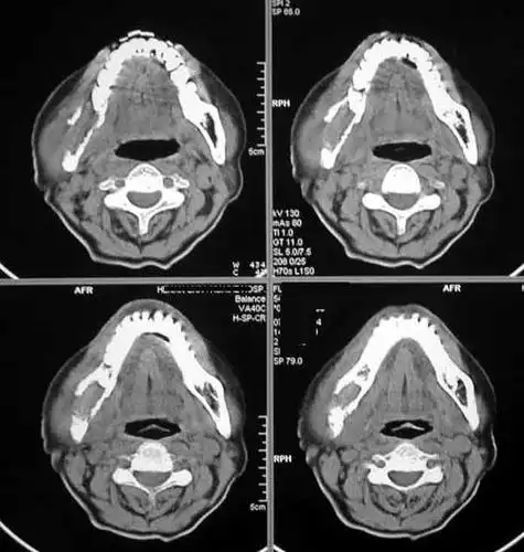 下颌骨占位分析-ct--已公布答案:4月27日