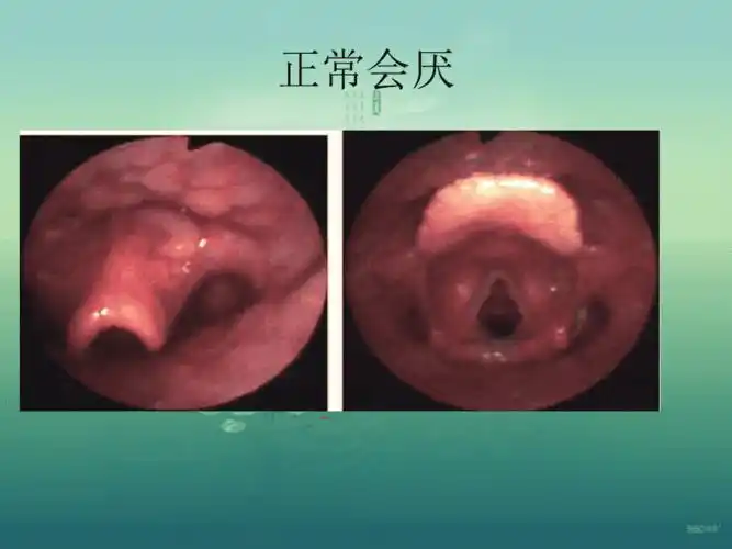 急性会厌炎的护理pptppt