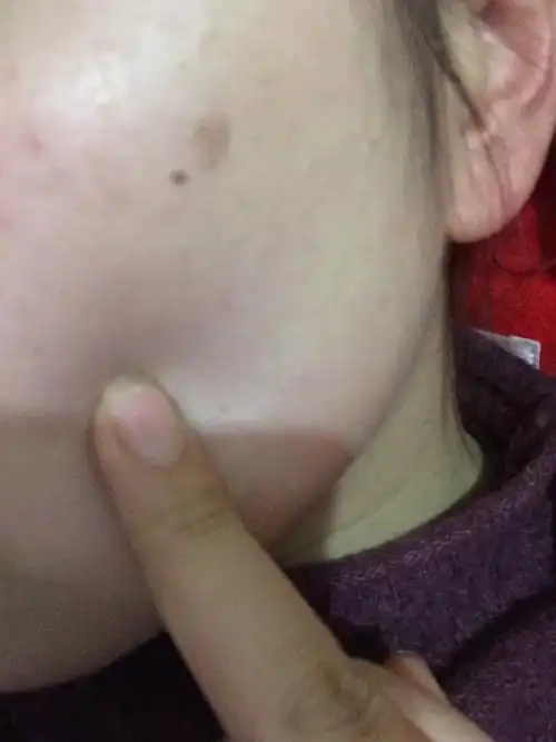 我脸上长了个扁平疣,这段时间越来越大了!上次去医院医生开了人工干
