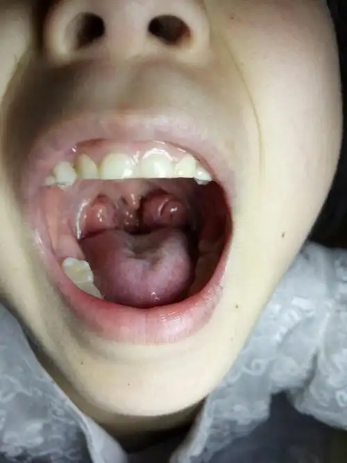 通常腺样体经验会在12岁左右逐渐退化,但是在退化之前,扁桃体可能会