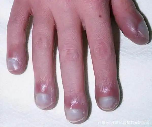 指甲的形状和颜色,能反映身体健康状况!快看看你是哪一种
