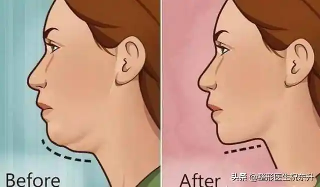 可以调整一些下巴形态不良的情况,还能抽吸颈阔肌外脂肪垫
