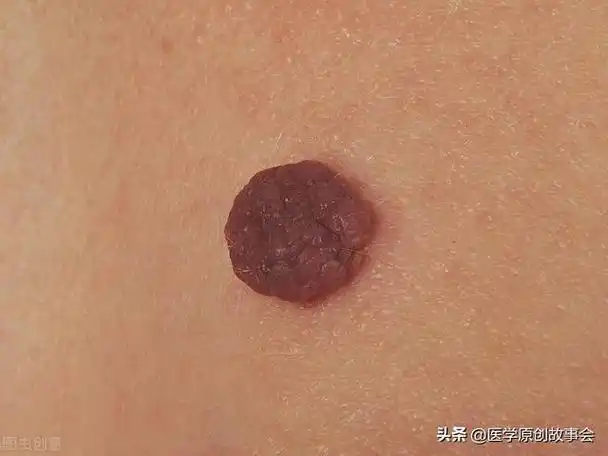 皮肤上长出一个个小肉球是怎么回事可以抠掉吗如何处理