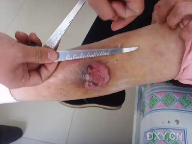 【讨论】89岁,女,左小腿菜花样肿物一年 [病例帖]