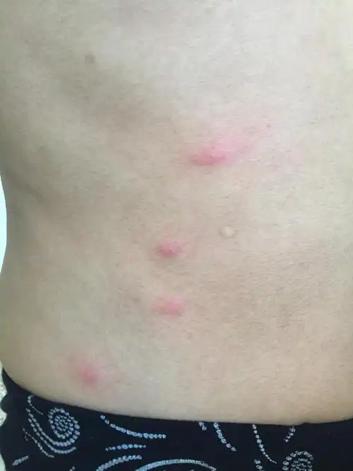 坐了动车之后脚踝起了很多红疙瘩还很痒,咋回事呢