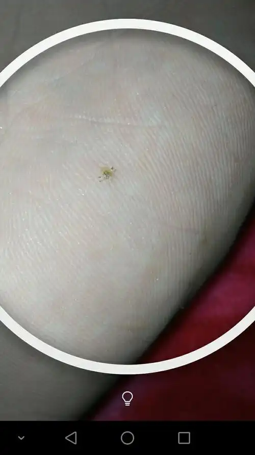 阴虱怎么去除,谁告诉我,谢谢,我好怕,会不会医不好,或者反复发作,这些