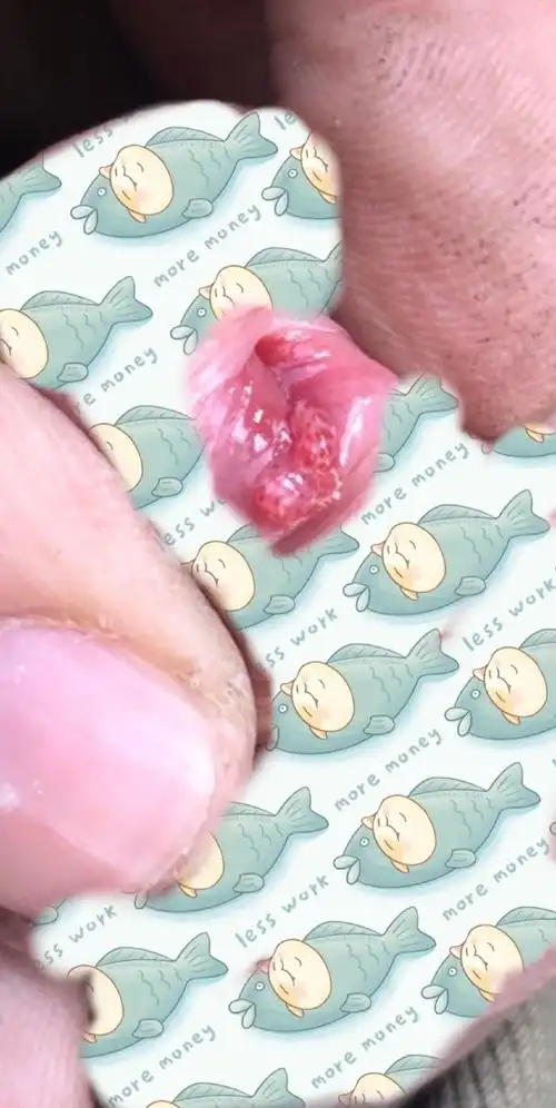 如果尖尖只是在尿道口,相对还好处理,如果长的位置更深