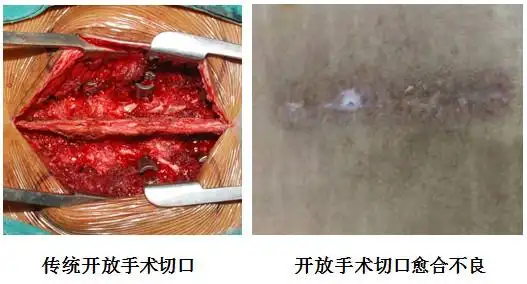 支配,萎缩,出现术后腰痛,腰无力等不适,严重影响生活;腰椎后路融合