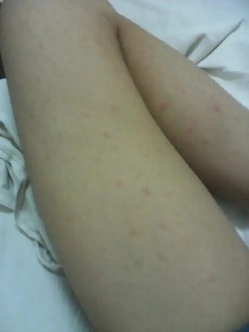 我之前有得过包皮龟头炎,吃过盐酸左氧氟沙星,罗红霉素胶囊,现