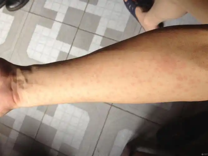 风疹,麻疹,药疹.还是梅毒?