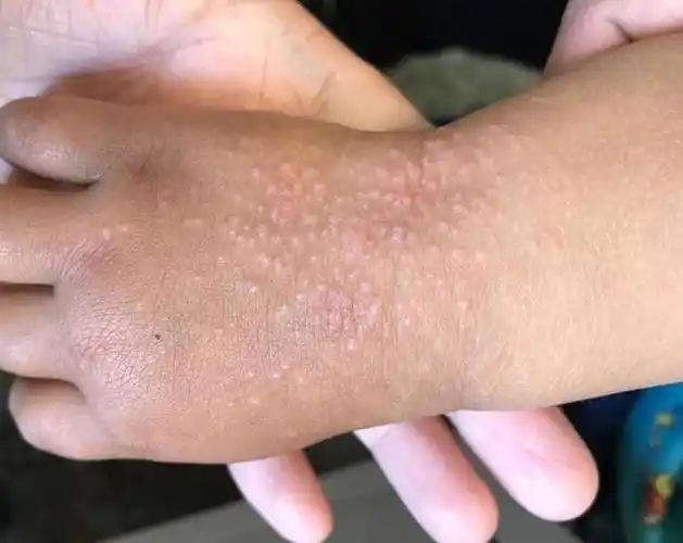 宝宝手背这么多疙瘩看着挺揪心的但问题不大