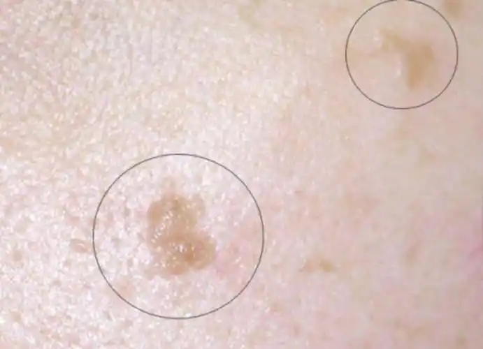 脚部扁平疣症状图片