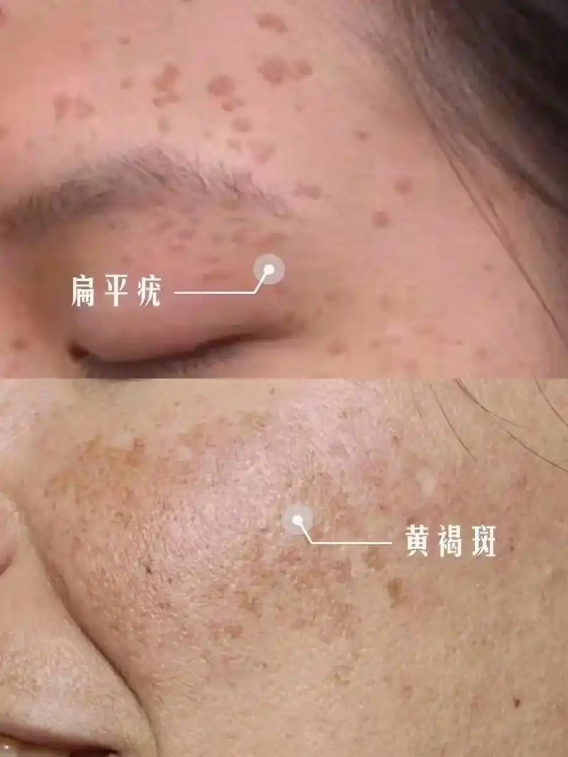 7815很多人错把疣当成斑,仔细观察一下,扁平疣是扁平凸起的,高