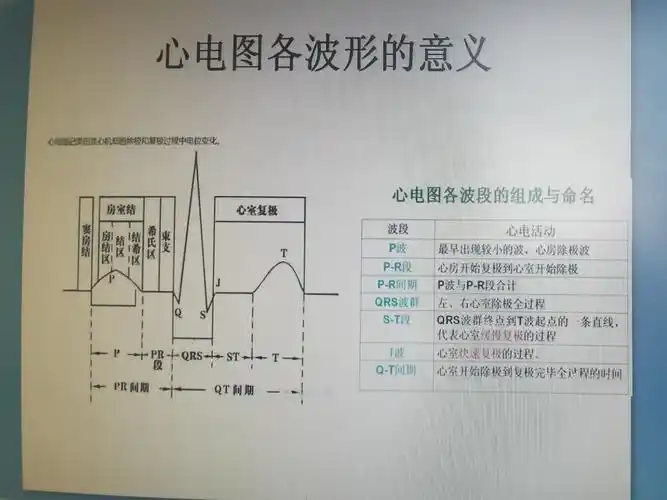 简单学习心电图 - 美篇