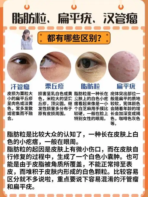 脂肪粒汗管瘤和扁平疣的区别究竟在哪里