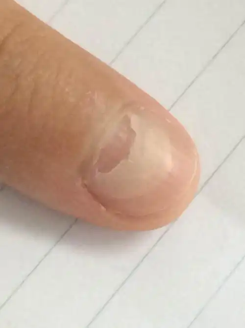 指甲出现分层,请问是什么情况?